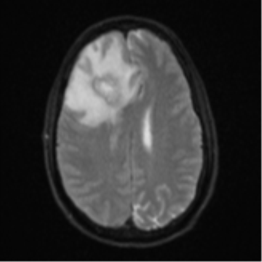 Cerebral abscess (Radiopaedia 60342-68009 Axial DWI 24).png