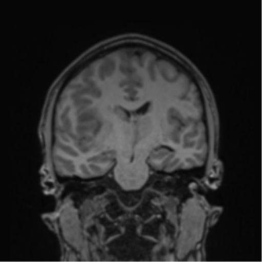 Cerebral abscess (Radiopaedia 60342-68009 Coronal T1 24).png
