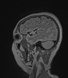 Cerebral abscess from pulmonary arteriovenous malformation (Radiopaedia 86275-102291 Sagittal FLAIR 18).png
