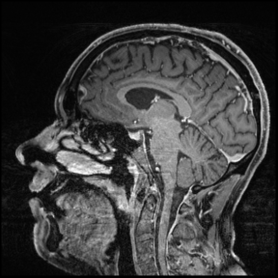 Cerebral abscess with ventriculitis (Radiopaedia 78965-91878 Sagittal T1 C+ 97).jpg
