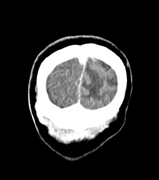 File:Cerebral abscesses (Radiopaedia 70458-80568 Coronal Contrast 61).jpg