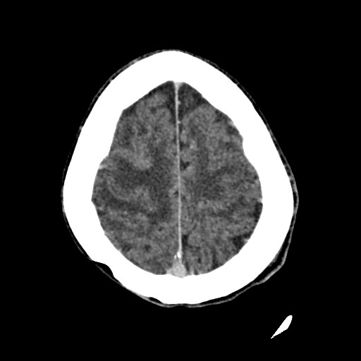 Cerebral amyloid angiopathy-related inflammation (Radiopaedia 74836-85848 Axial non-contrast 50).jpg