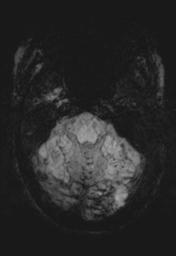 File:Cerebral amyloid angiopathy (Radiopaedia 29129-29518 Axial SWI MIP 7).jpg