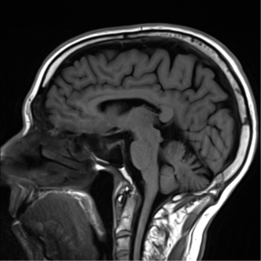 File:Cerebral amyloid angiopathy (Radiopaedia 46082-50433 Sagittal T1 15).png