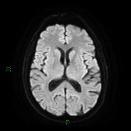 File:Cerebral amyloid angiopathy (Radiopaedia 77506-89664 Axial DWI 16).jpg
