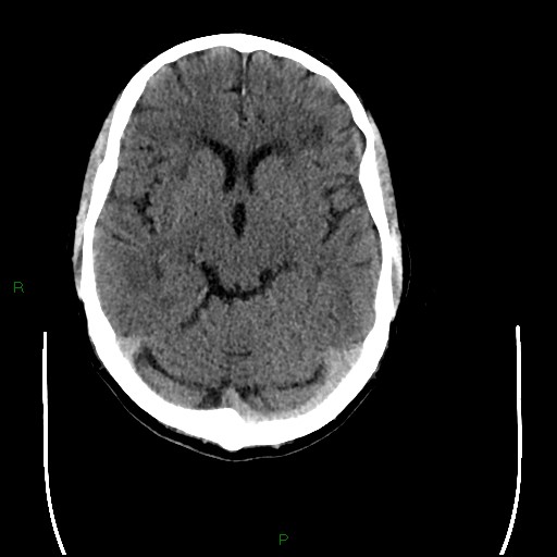 Cerebral amyloid angiopathy (Radiopaedia 77506-89665 Axial non-contrast 44).jpg
