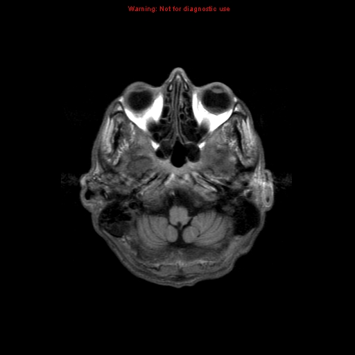 File:Cerebral and orbital tuberculomas (Radiopaedia 13308-13311 Axial T1 4).jpg