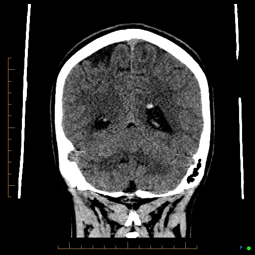 Cerebral arteriovenous malformation (AVM) (Radiopaedia 78162-90706 Coronal non-contrast 71).jpg