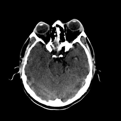 Cerebral arteriovenous malformation (Radiopaedia 28518-28759 Axial non-contrast 24).jpg