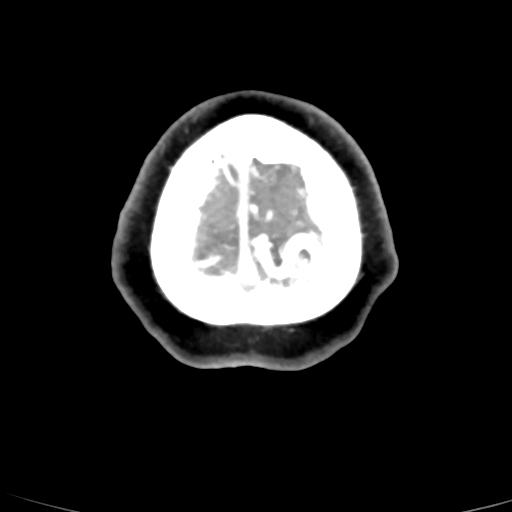 File:Cerebral arteriovenous malformation (Radiopaedia 73830-84645 B 7).jpg