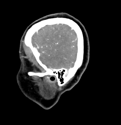Cerebral arteriovenous malformation (Radiopaedia 73830-84645 D 12).jpg
