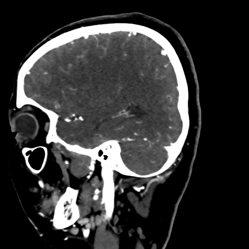 Cerebral arteriovenous malformation (Radiopaedia 73830-84645 Sagittal C+ delayed 25).jpg