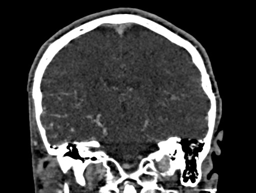 Cerebral arteriovenous malformation (Radiopaedia 78188-90746 Coronal C+ delayed 68).jpg