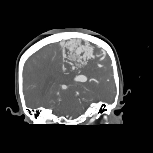 File:Cerebral arteriovenous malformation (Radiopaedia 79677-92888 B 25).jpg