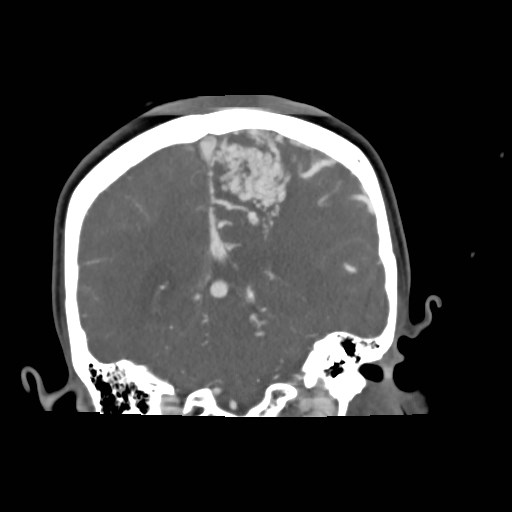 File:Cerebral arteriovenous malformation (Radiopaedia 79677-92888 B 28).jpg