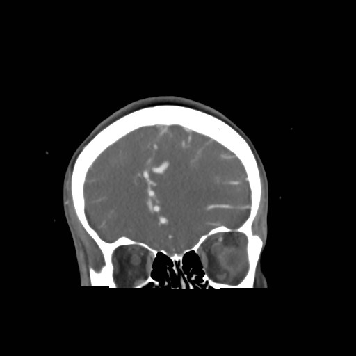 File:Cerebral arteriovenous malformation (Radiopaedia 79677-92888 B 6).jpg