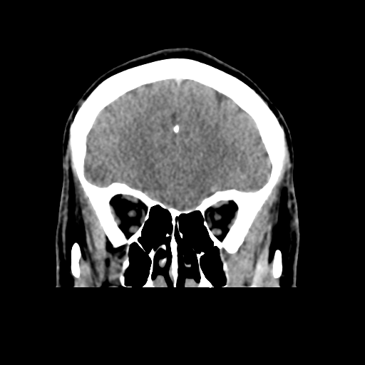 Cerebral arteriovenous malformation (Spetzler-Martin grade 2) (Radiopaedia 41262-44076 Coronal non-contrast 15).png