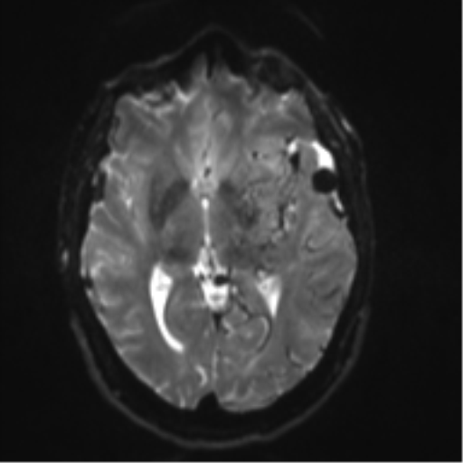 File:Cerebral arteriovenous malformation - huge (Radiopaedia 35734-37272 Axial DWI 11).png