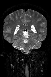 Cerebral arteriovenous malformation at posterior body of corpus callosum (Radiopaedia 74111-84925 Coronal T2 117).jpg