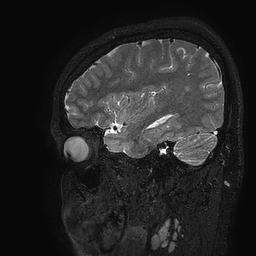 Cerebral arteriovenous malformation at posterior body of corpus callosum (Radiopaedia 74111-84925 Sagittal T2 104).jpg