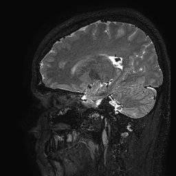 Cerebral arteriovenous malformation at posterior body of corpus callosum (Radiopaedia 74111-84925 Sagittal T2 87).jpg