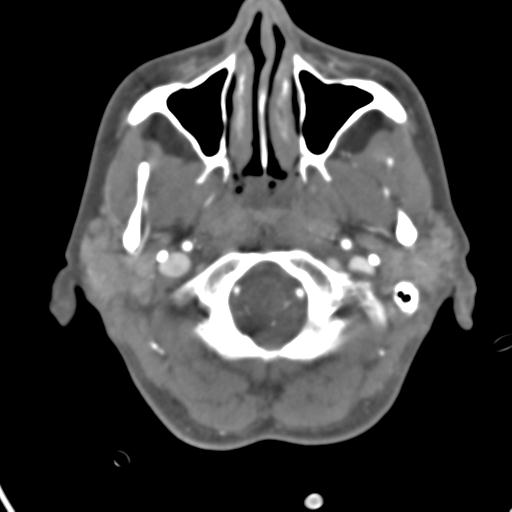 Cerebral arteriovenous malformation with hemorrhage (Radiopaedia 28773-29073 A 49).jpg