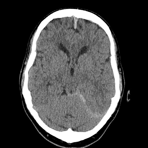 Cerebral arteriovenous malformation with lobar hemorrhage (Radiopaedia 35598-37117 Axial non-contrast 21).jpg
