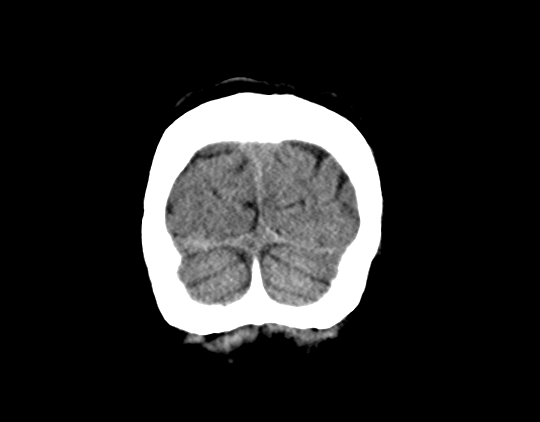 Cerebral arteriovenous malformation with lobar hemorrhage (Radiopaedia 44725-48510 Coronal non-contrast 43).png