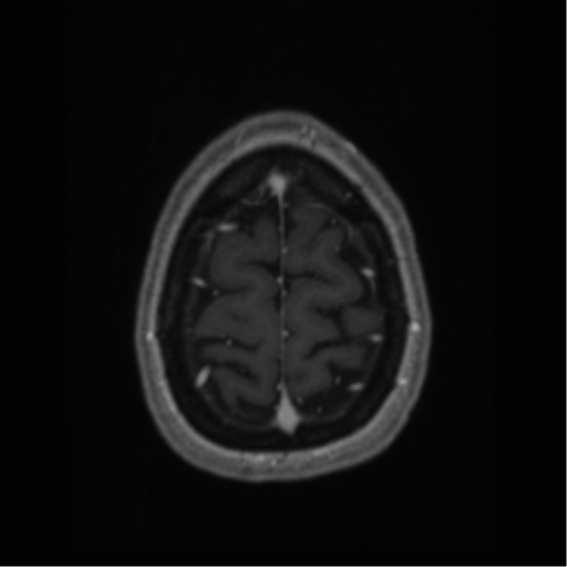 Cerebral cavernoma and development venous anomaly (Radiopaedia 37603-39482 Axial T1 C+ 68).png