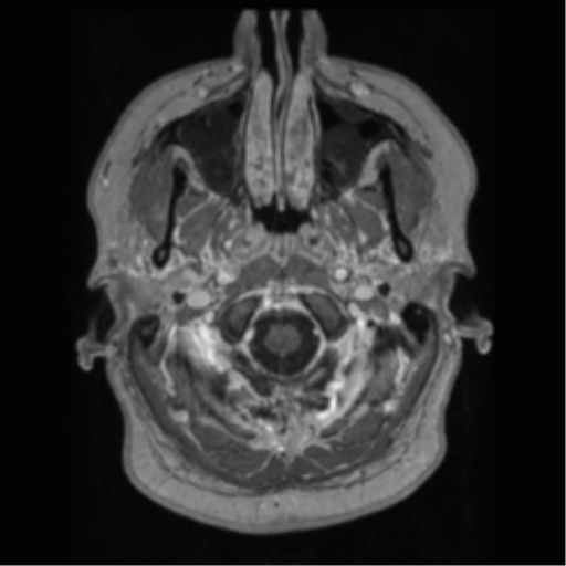 Cerebral cavernoma and development venous anomaly (Radiopaedia 37603-39482 Axial T1 C+ 7).png