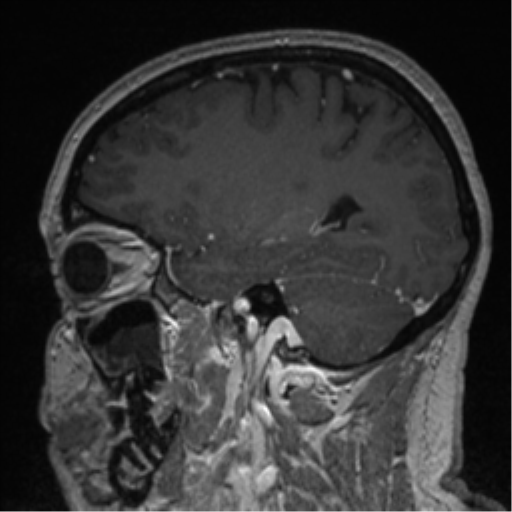 File:Cerebral cavernoma and development venous anomaly (Radiopaedia 37603-39482 Sagittal T1 C+ 65).png