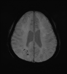 Cerebral embolic infarcts (embolic shower) (Radiopaedia 72391-82921 Axial SWI 50).jpg