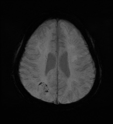 Cerebral embolic infarcts (embolic shower) (Radiopaedia 72391-82921 Axial SWI 51).jpg