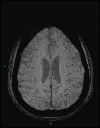 Cerebral fat embolism (Radiopaedia 35022-36525 Axial SWI 35).jpg
