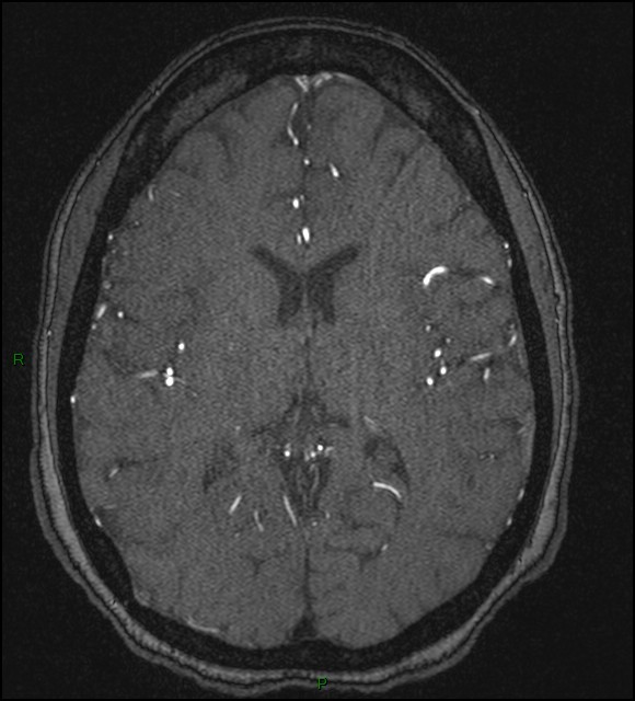 Cerebral fat embolism (Radiopaedia 35022-36525 Axial TOF 117).jpg
