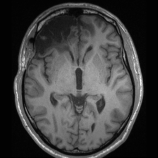 Cerebral hemorrhagic contusions- temporal evolution (Radiopaedia 40224-42757 Axial T1 36).png