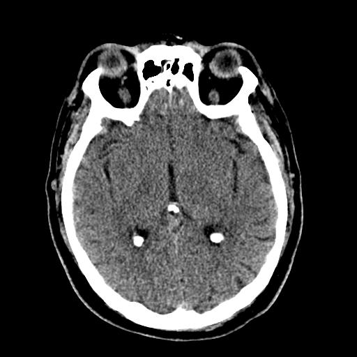 File:Cerebral hemorrhagic contusions and cervical spine fractures (Radiopaedia 32865-33841 Axial non-contrast 17).jpg