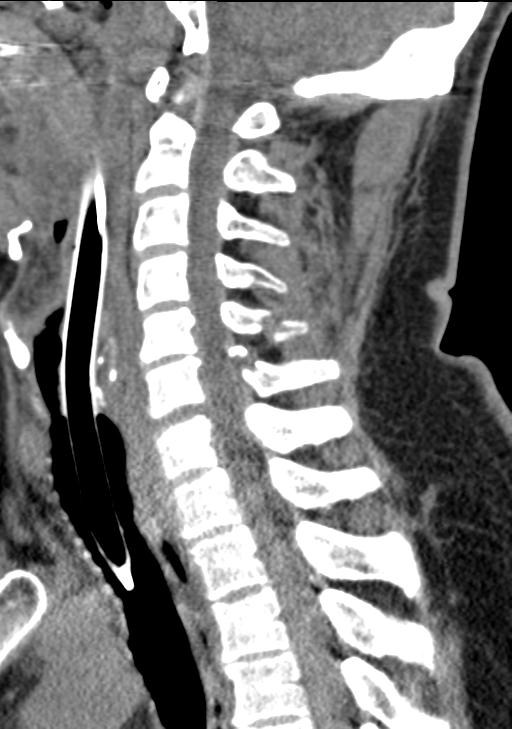 Cerebral hemorrhagic contusions and cervical spine fractures (Radiopaedia 32865-33841 G 56).jpg