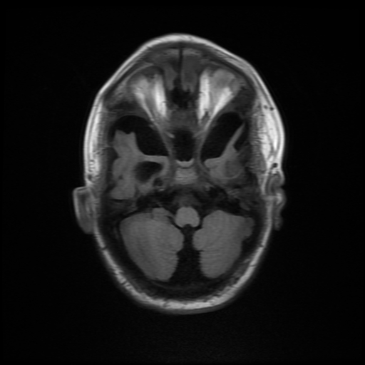 File:Cerebral manifestations of mucopolysaccharidosis type I (Radiopaedia 59171-66487 C 4).jpg