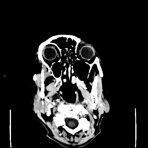 File:Cerebral metastases - breast primary (Radiopaedia 77653-89857 Axial C+ delayed 2).jpg