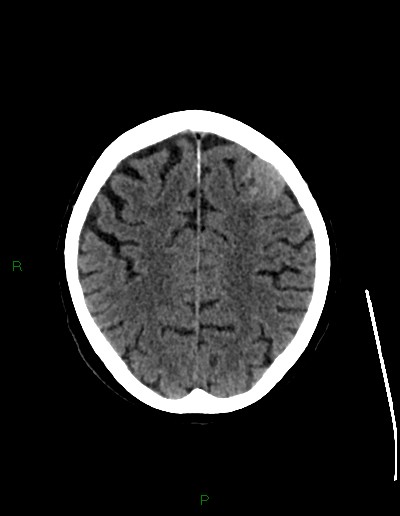Cerebral metastases - ependymal and parenchymal (Radiopaedia 79877-93131 Axial non-contrast 58).jpg