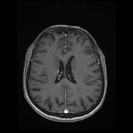 Cerebral metastases - melanoma (Radiopaedia 80972-94522 Axial T1 C+ 62).jpg