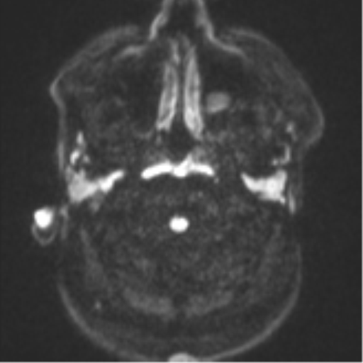 Cerebral metastases mimicking multifocal glioblastoma (Radiopaedia 50843-56353 Axial DWI 29).png