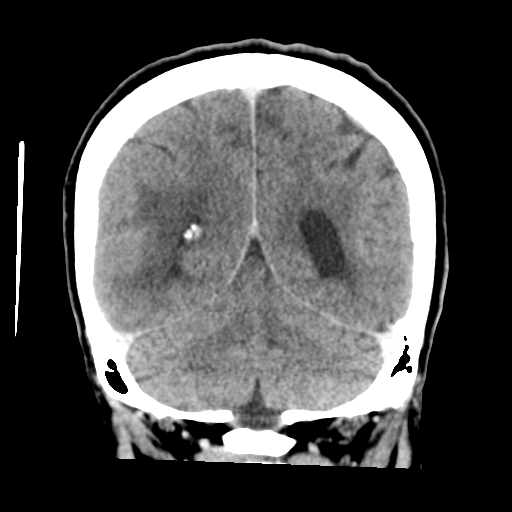 Cerebral metastasis to basal ganglia (Radiopaedia 81568-95412 Coronal C+ delayed 45).png