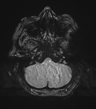 Cerebral metastasis to basal ganglia (Radiopaedia 81568-95413 Axial SWI magnitude 12).png