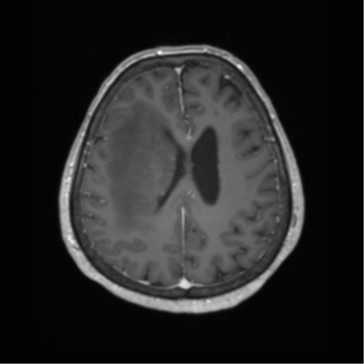 Cerebral metastasis to basal ganglia (Radiopaedia 81568-95413 Axial T1 C+ 51).png