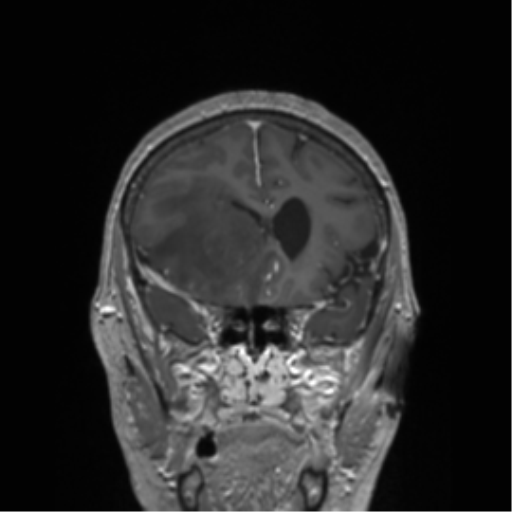 File:Cerebral metastasis to basal ganglia (Radiopaedia 81568-95413 Coronal T1 C+ 43).png
