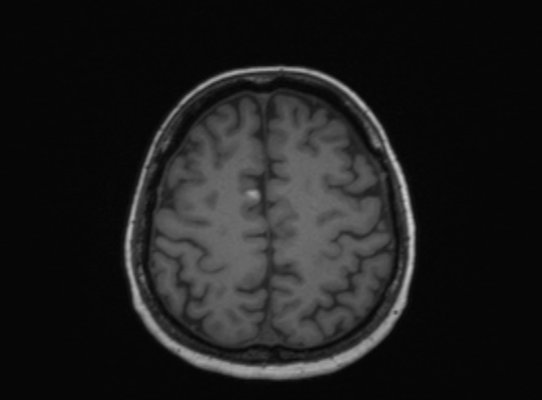 Cerebral ring enhancing lesions - cerebral metastases (Radiopaedia 44922-48817 Axial T1 155).jpg