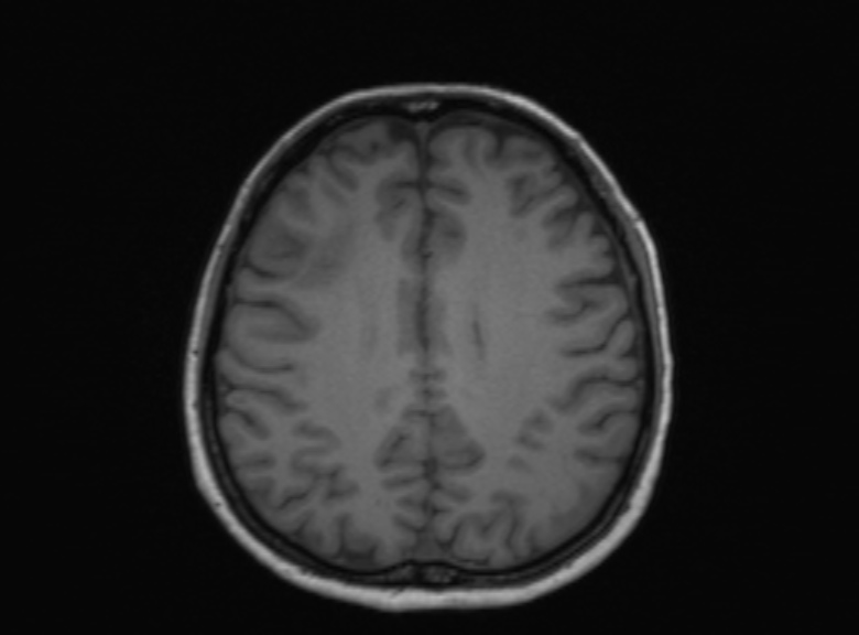Cerebral ring enhancing lesions - cerebral metastases (Radiopaedia 44922-48817 Axial T1 182).jpg