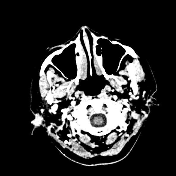 File:Cerebral ring enhancing lesions - cerebral metastases (Radiopaedia 44922-48818 B 13).jpg